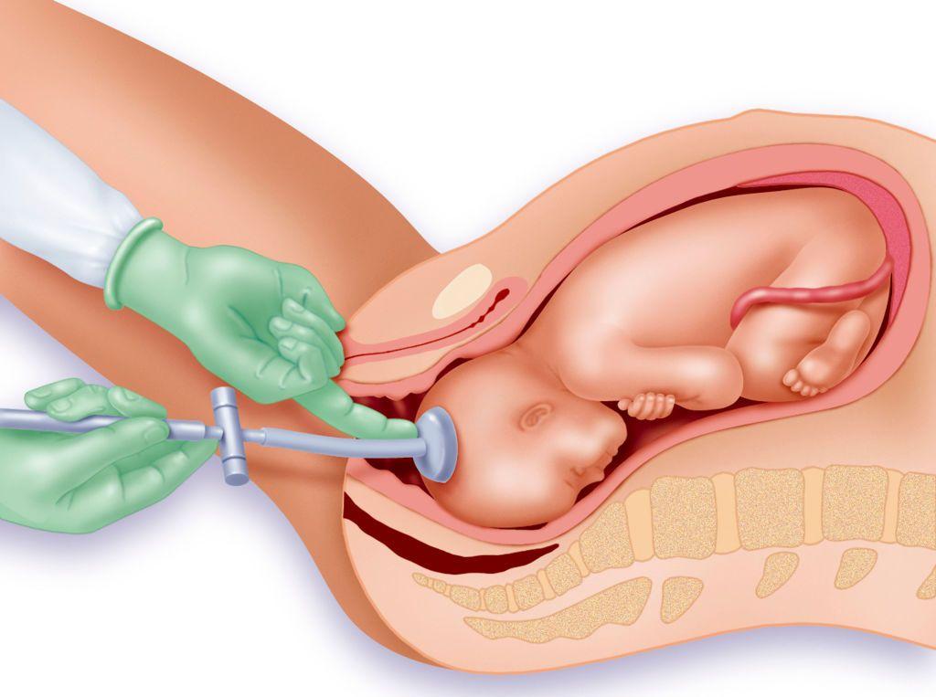 Ilustraci&oacute;n de la venosa obst&eacute;trica, en la se ve como una copa de succi&oacute;n se pega a un beb&eacute; mientra para ayudarlo a salir por la vagina.