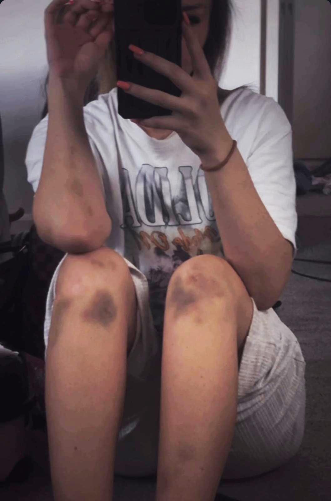 Una selfi de Rebecca sentada, con el rostro oculto tras su tel&eacute;fono m&oacute;vil. Lleva pantalones cortos grises y presenta hematomas oscuros en ambas rodillas, as&iacute; como moratones que se extienden por los brazos.
