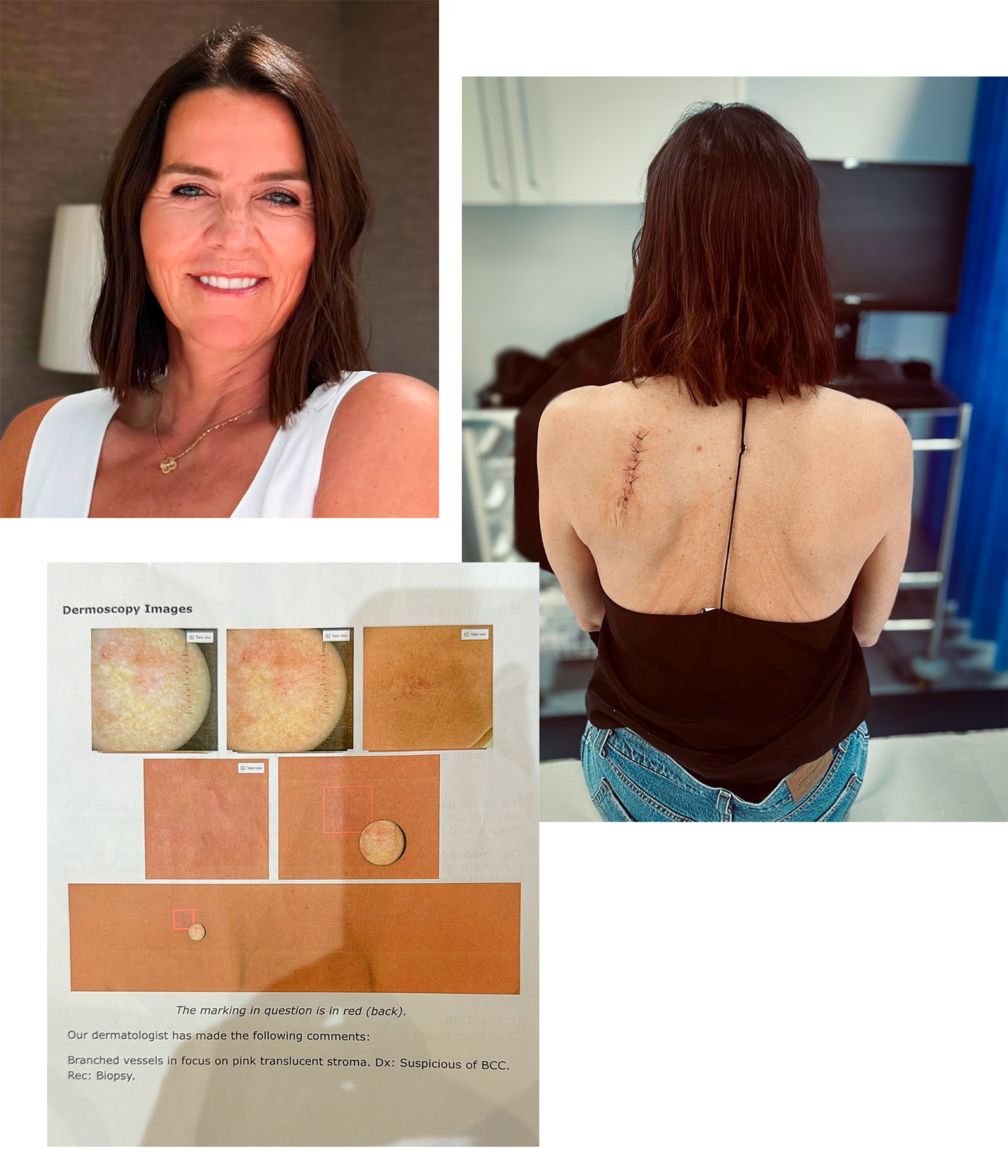 Una foto de Annabel, una imagen del escáner de su piel y una foto de ella de espaldas mostrando una cicatriz postoperatoria