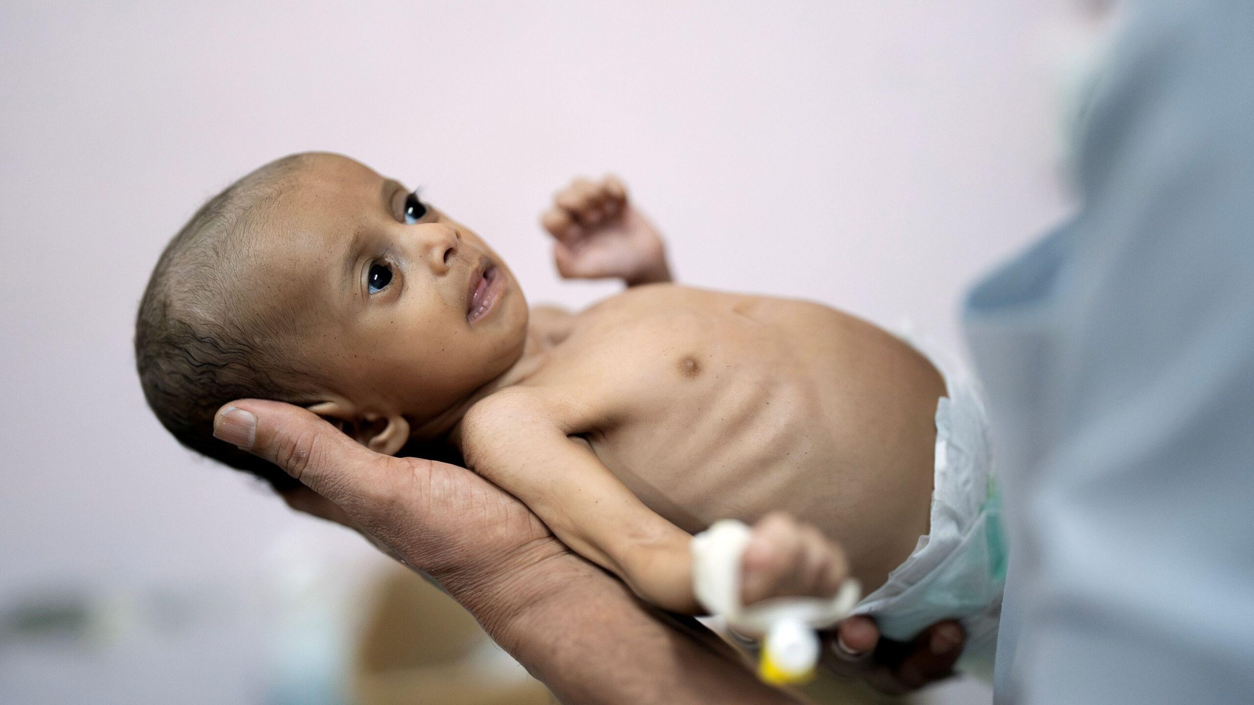Raghad Hassan, una niña desnutrida, en un hospital de Adén, Yemen.