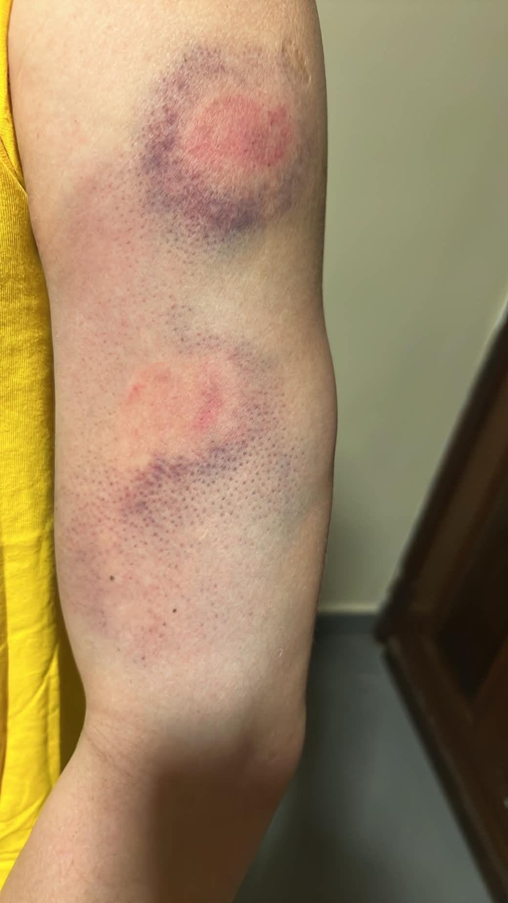 El brazo de uno de los deportados a República Centroafricana, en el que se ven sendos hematomas.