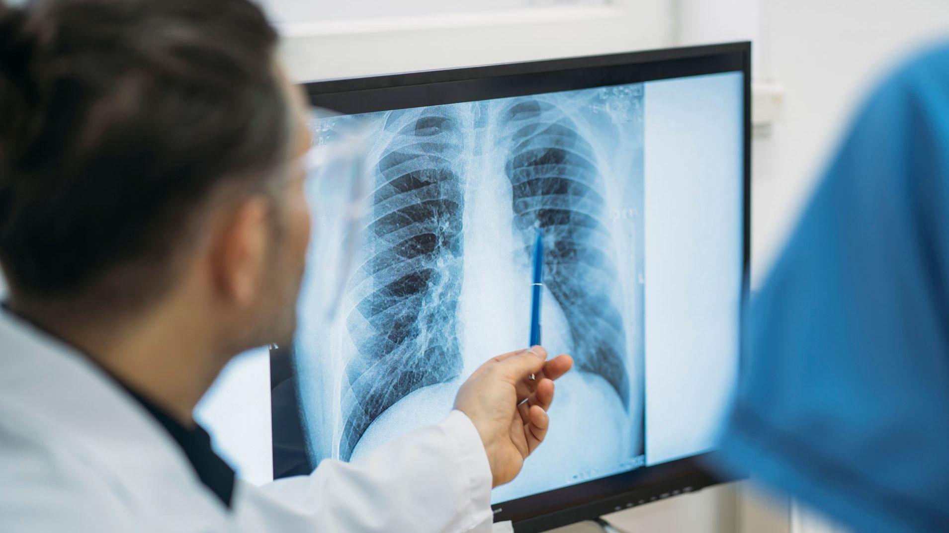 Qué es un adenocarcinoma pulmonar, el tipo de tumor maligno que le extirparon al papa León XIV