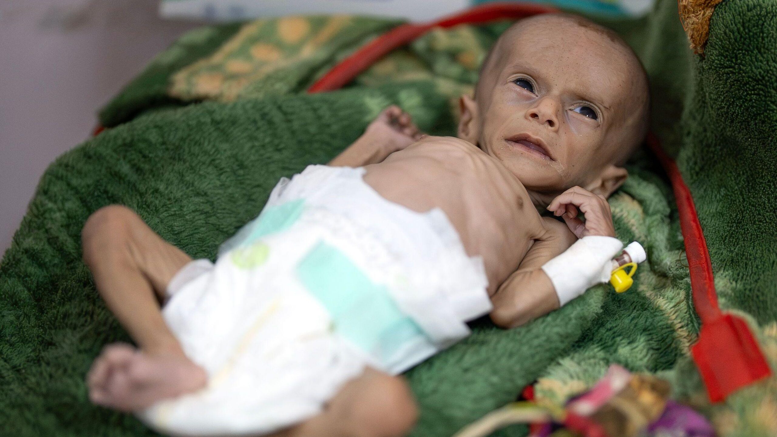 Raad Hassan, un niño desnutrido, en un hospital de Adén, Yemen.
